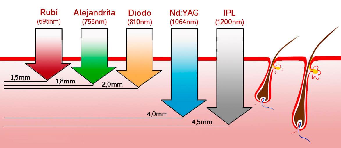 Tipos de depilacion laser