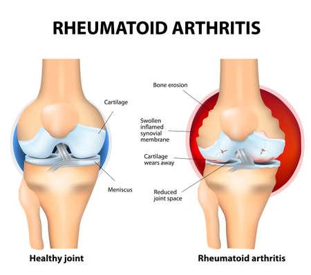 la artritis reumatoide