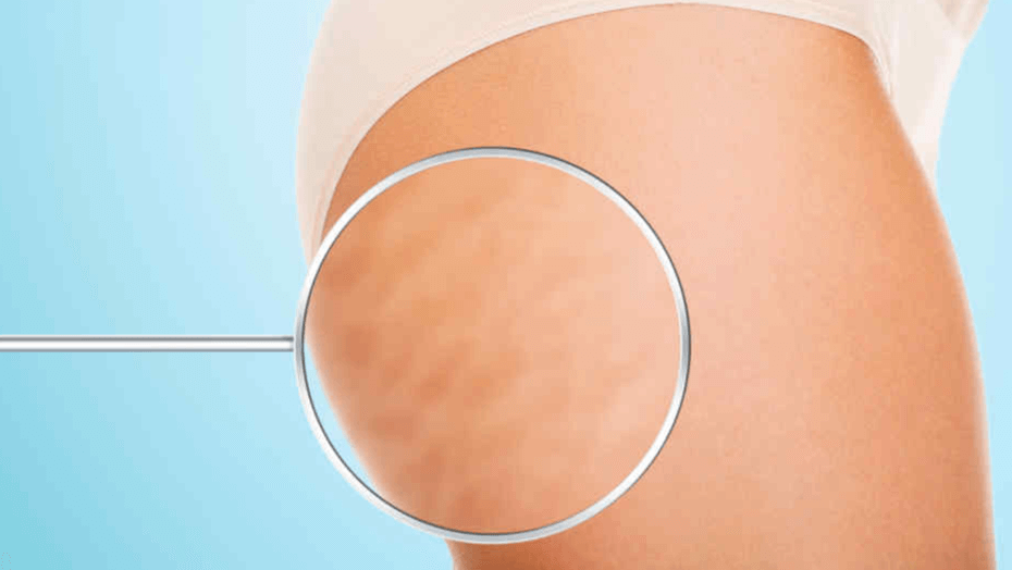 celulitis2