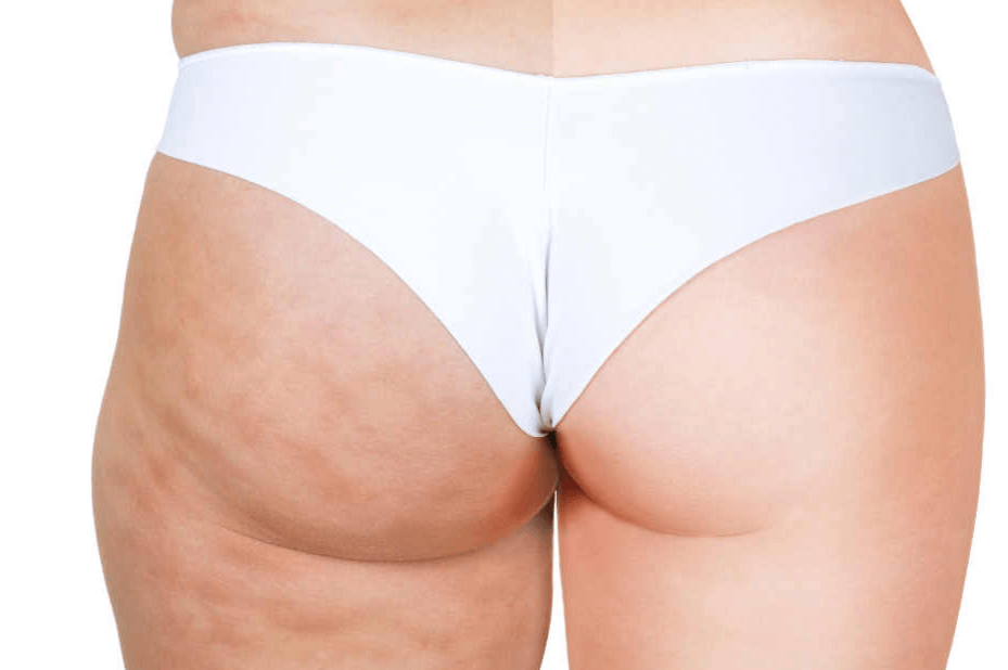 celulitis