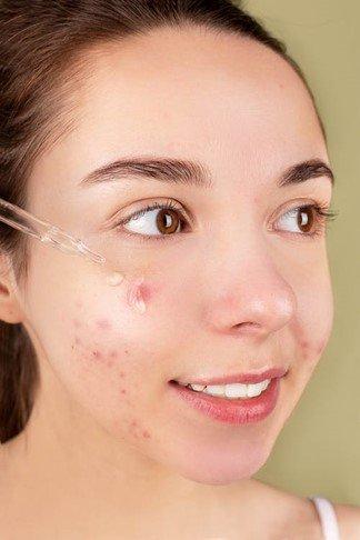 tratamiento del acné