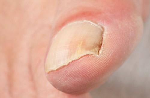 Onicomicosis-500x325