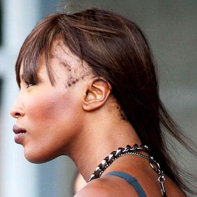 Thinning-hair-400x400