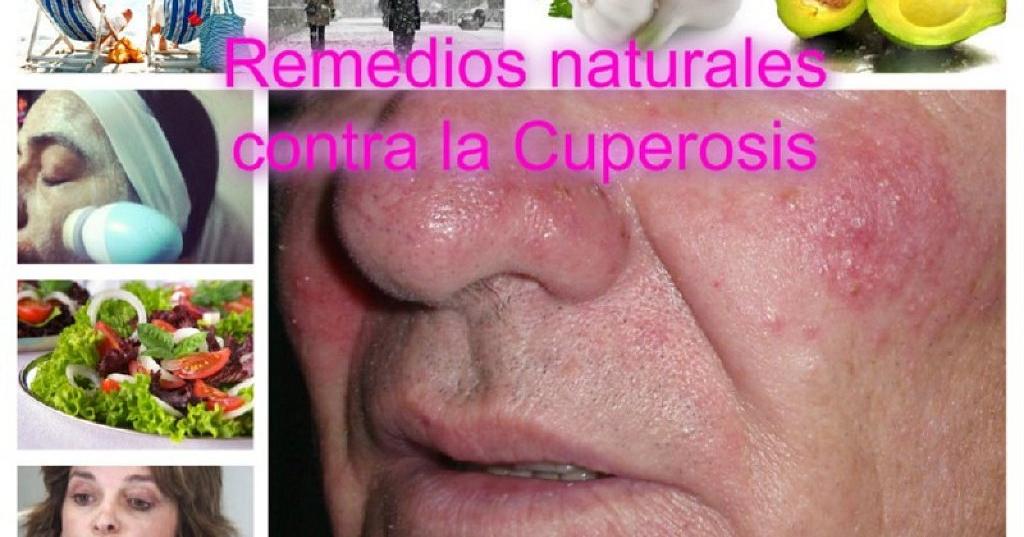 Remedios Naturales Contra La Cuperosis Salud