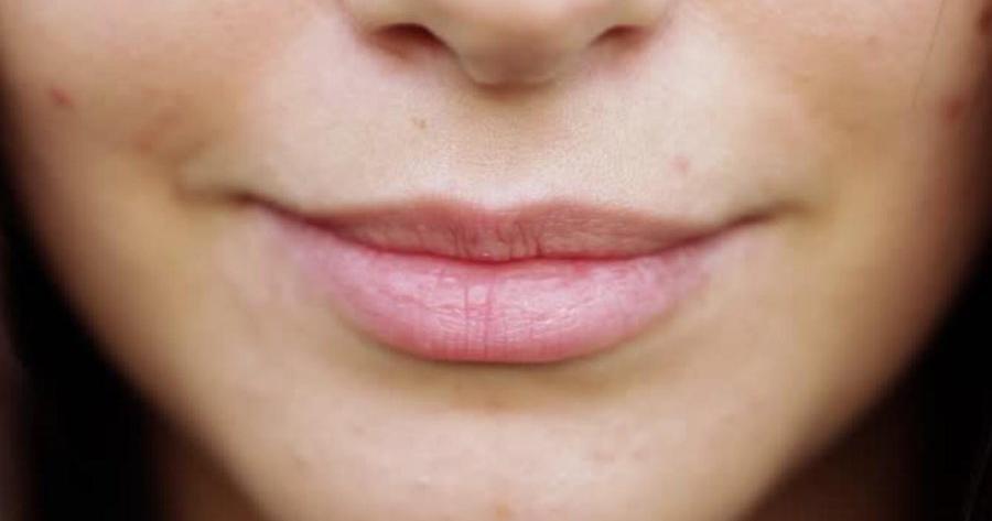 2 remedios caseros para aliviar el herpes labial | Salud