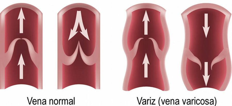 Varices