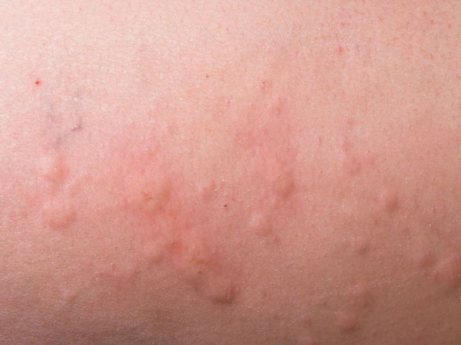 eccema