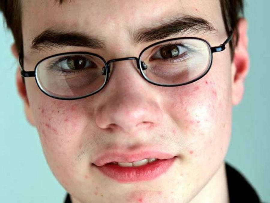 adolescente con acné