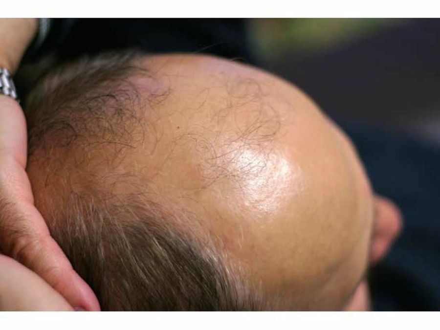 alopecia