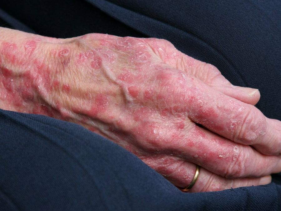 psoriasis