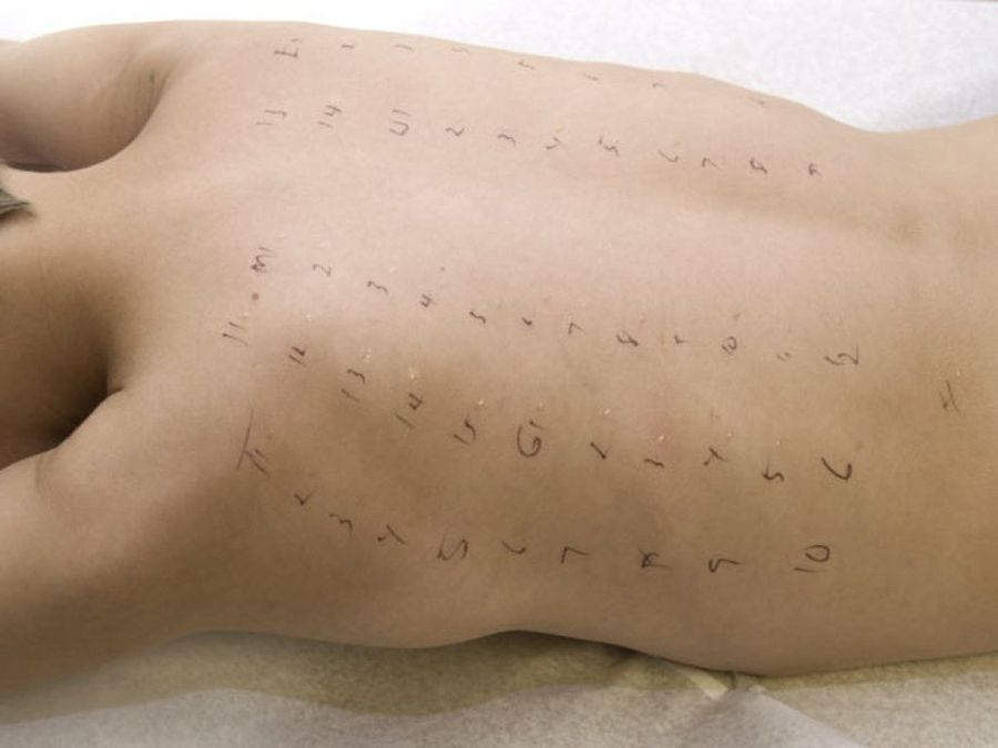 pruebas alergia