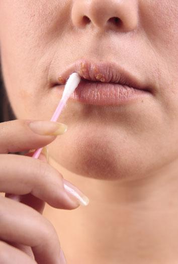 remedios-caseros-herpes