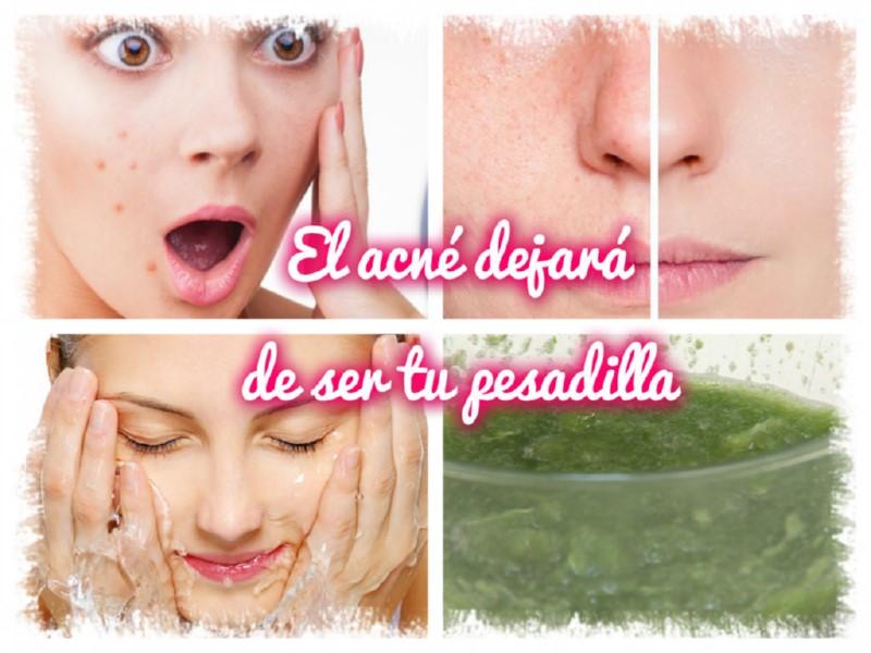 El acné dejará de ser tu pesadilla