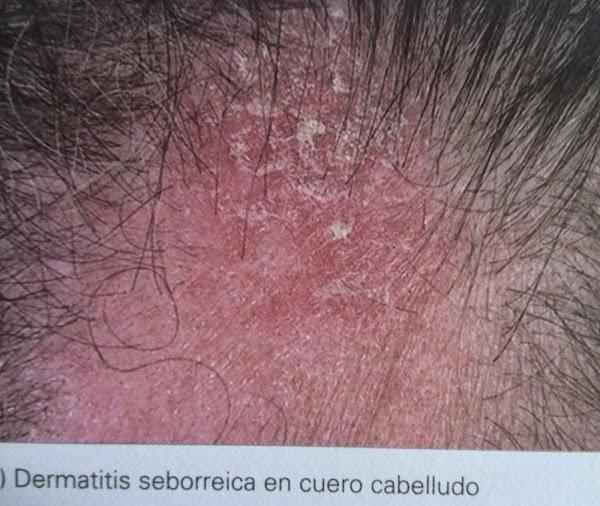 cuero cabelludo seborreica