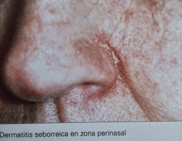 nariz dermatitis