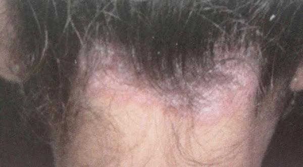 psoriasis cuero cabelludo