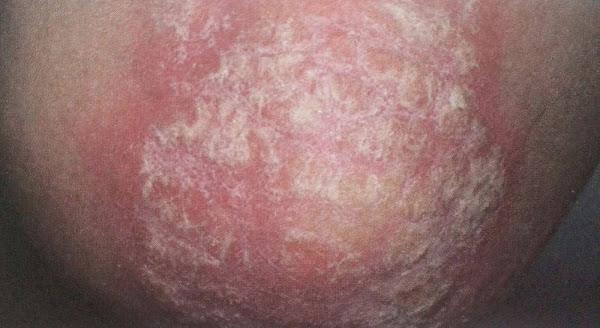 psoriasis codo
