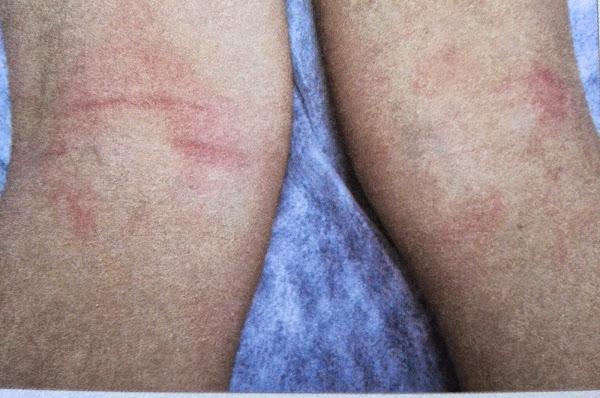 dermatitis atópica flexural