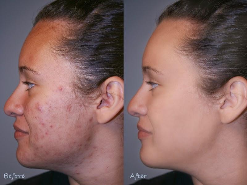 manchas-acne