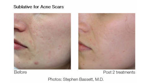 Eliminar las marcas de acné