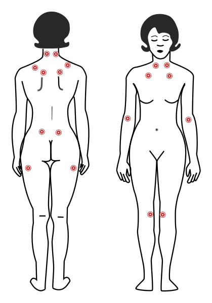 fibromialgia