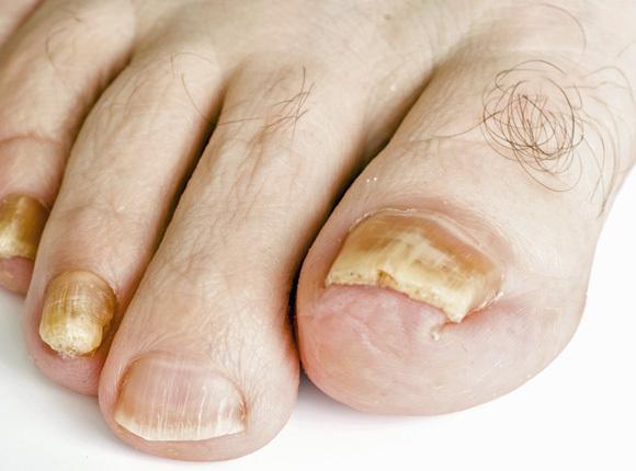 Toenail Fungus