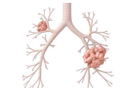 Cáncer de pulmón