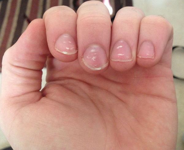 uñas con manchas blancas