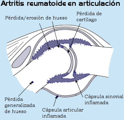Artritis en las manos. Cómo reducir sus dolores de forma natural