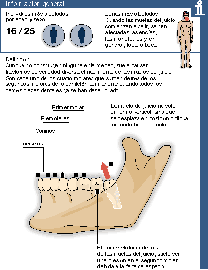 Muelas del juicio informacion general