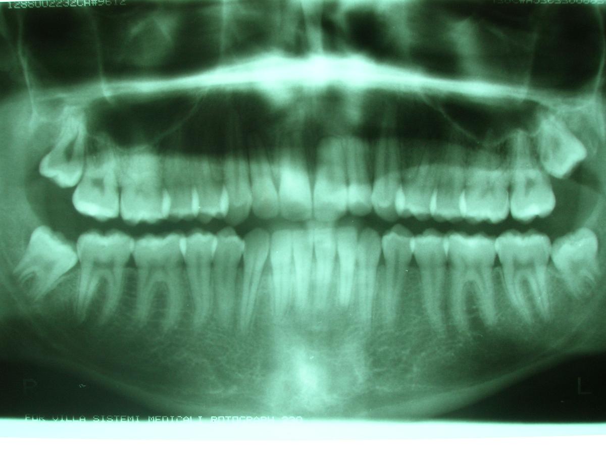 Muelas del juicio radiografia panoramica