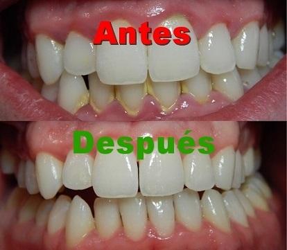 Gingivitis o inflamación de las encías. Remedios naturales