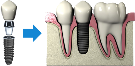 Implante dental en Madrid que saber