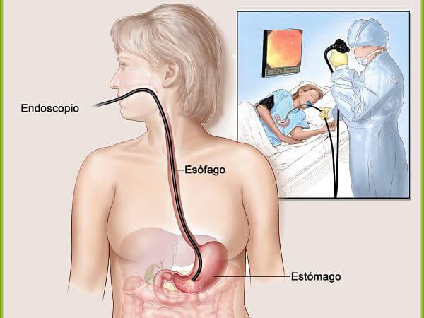 Endoscopia digestiva superior