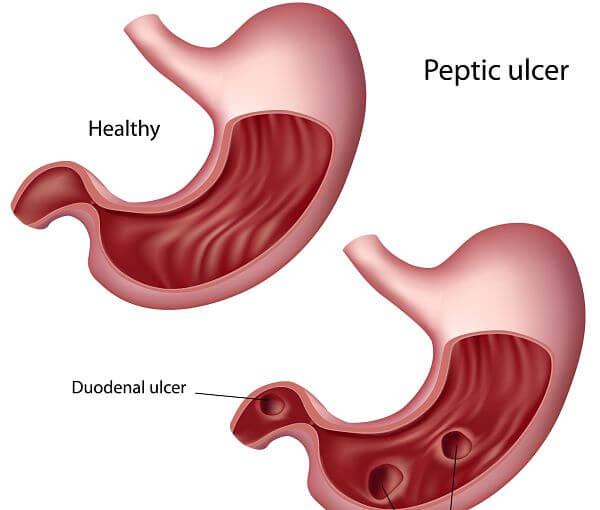 Complicaciones de la gastritis crónica