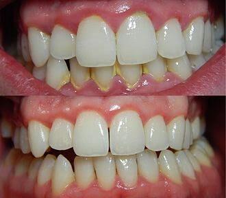 gingivitis y bacterias