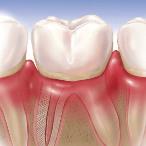 gingivitis por bacterias