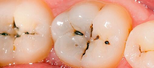 caries en dientes