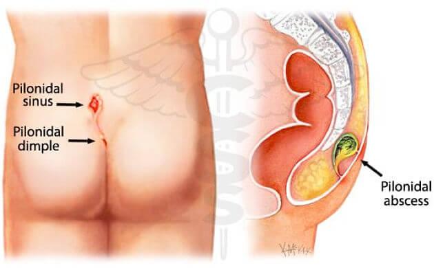 Quiste pilonidal