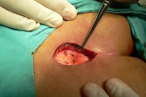 Resolución quirúrgica