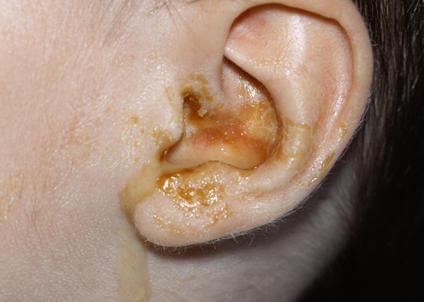 otitis 3