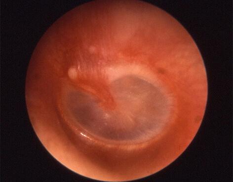 otitis 4