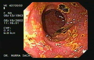 úlcera duodenal