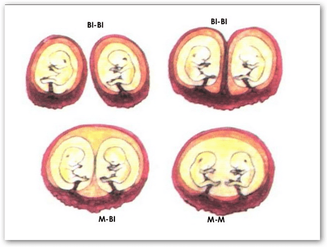 embarazo múltiple variedades monocigotos