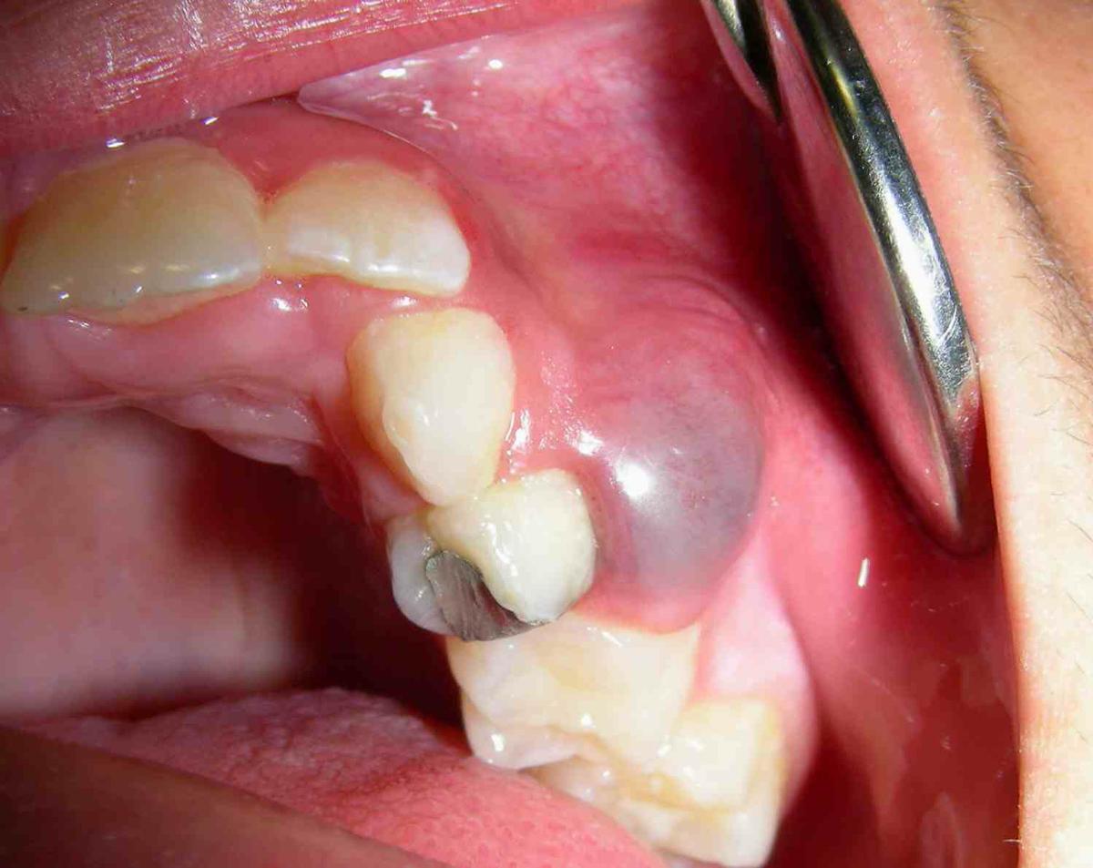 patologia periapical