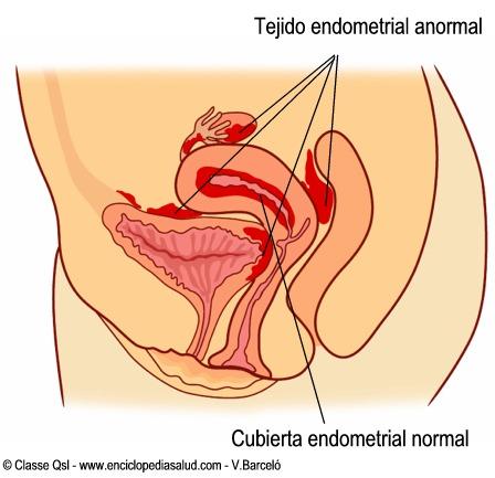 endometriosis