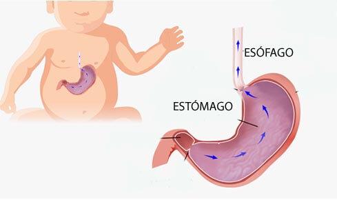 reflujo