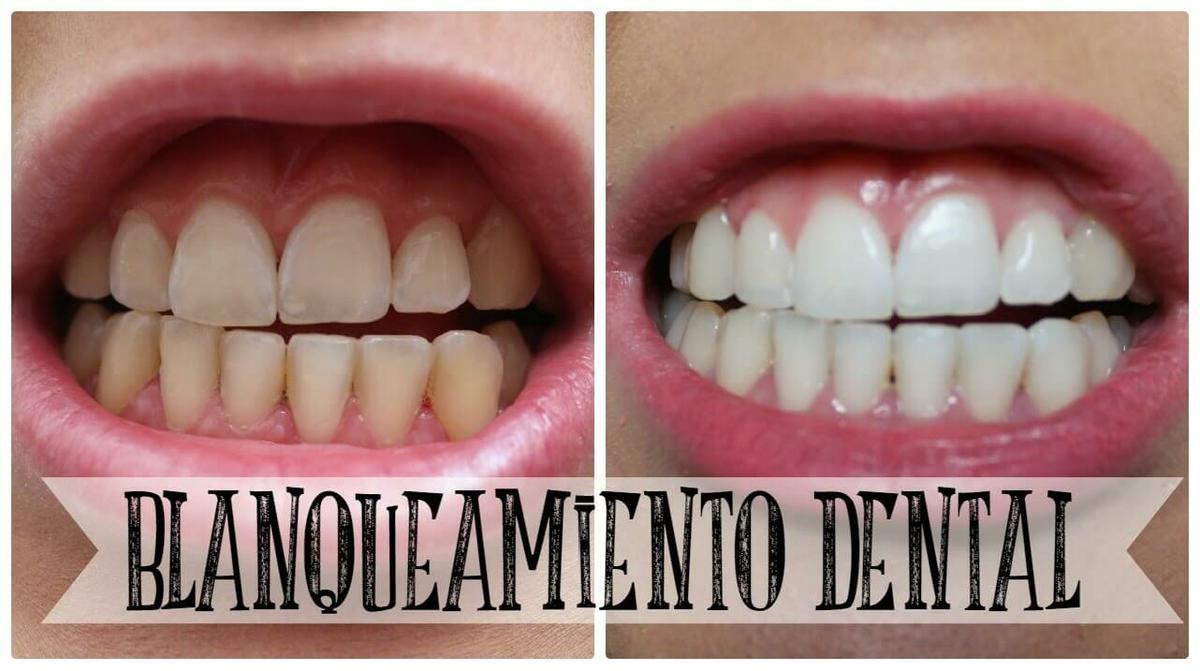 blanqueamiento de dientes