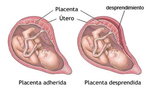 desprendimiento prematuro de placenta normoinsertada 1