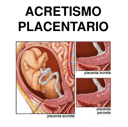 acretismo placentario